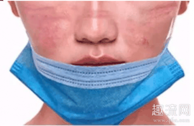 佩戴前应检查潮牌品牌口罩说明书（戴口罩脸上痒怎么办 为什么戴口罩脸部容易过敏）