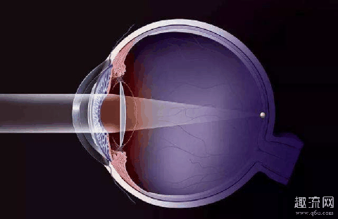 近视激光手术要求 近视激光手术风险